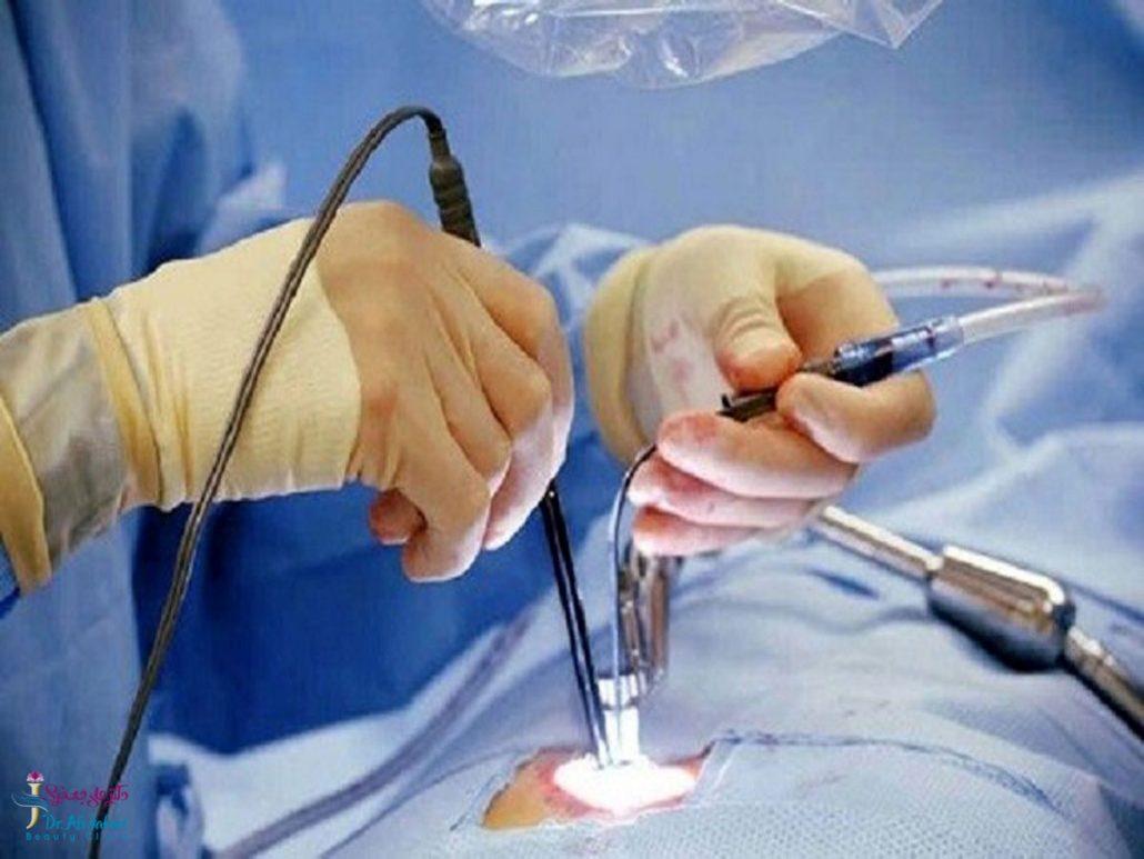 همه چیز درباره لاپاراسکوپی در جراحی‌های لاغری: روش‌ها، مزایا و آینده درمان چاقی