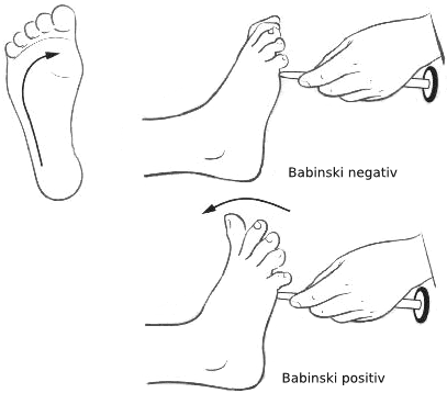 رفلکس بابینسکی