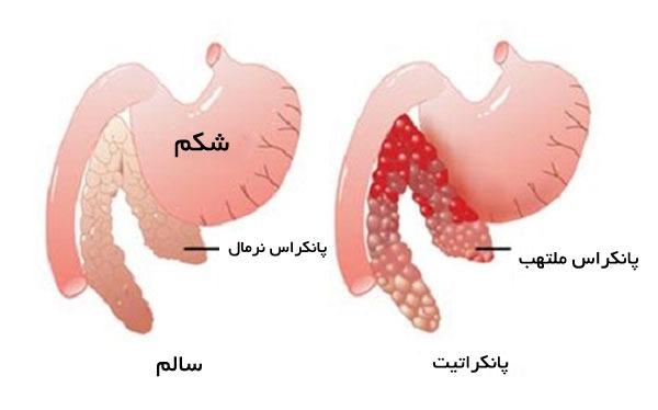 پانکراتیت