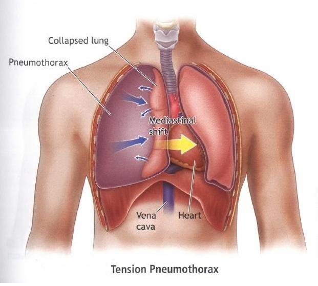 پنوموتوراکس