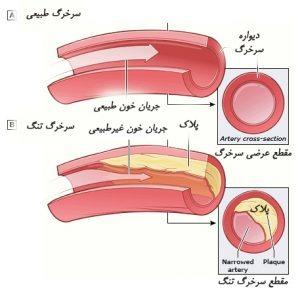 آترواسکلروز