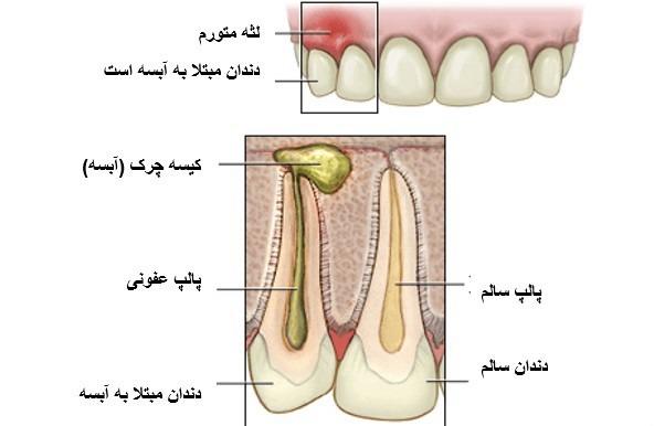 آبسه دندان