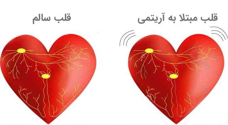 آریتمی قلب