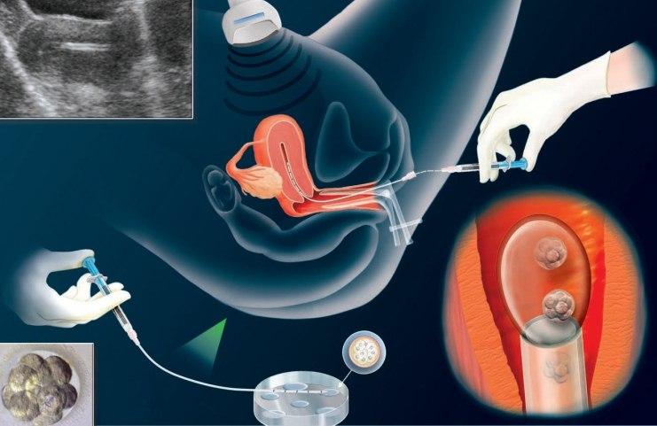 عوارض آی وی اف (IVF): بررسی جامع و راه‌های کاهش خطرات