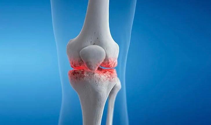 راه‌های مؤثر برای پیشگیری از آرتروز: نکات طلایی برای حفظ سلامت مفاصل