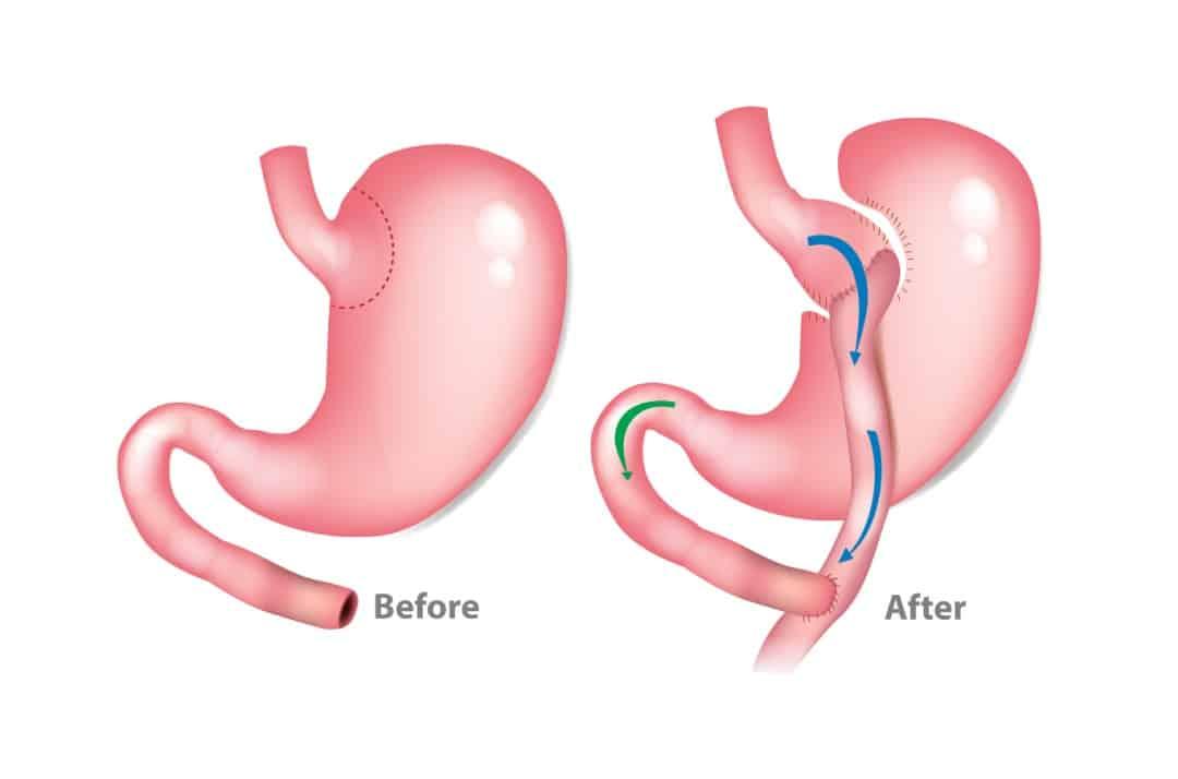 مقاله با موضوع عوارض عمل بای پس معده: بررسی جامع و راه‌های پیشگیری