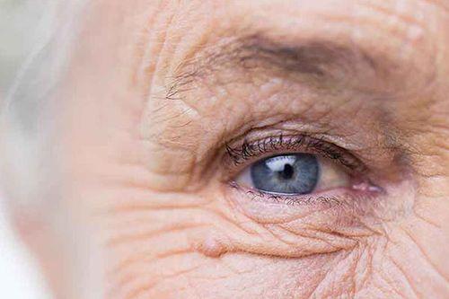 پیرچشمی (Presbyopia): علل، علائم و روش‌های درمان مؤثر