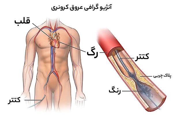 آنژیوگرافی قلب: روش انجام، مزایا و عوارض احتمالی بعد از آن